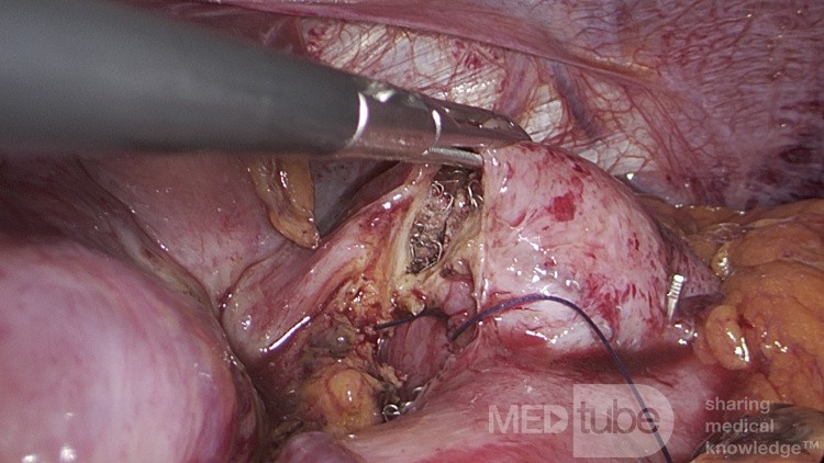 Perforacja owrzodzenia w żołądku resztkowym wiele lat po operacji bariatrycznej typu gastric bypass z pojedynczą anastomozą