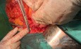 Operacja Whipple'a - pankreatoduodenektomia 