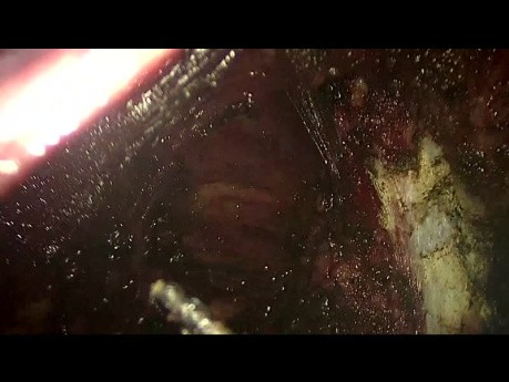 Endometrioza "bardzo" głęboko naciekająca