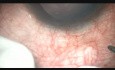 Angle Recession Glaucoma with Traumatic Mydriasis, Microtrack Filtration