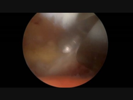 Endoskopowa discektomia