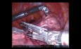 Prawostronna segmentektomia tylna górna z użyciem robota