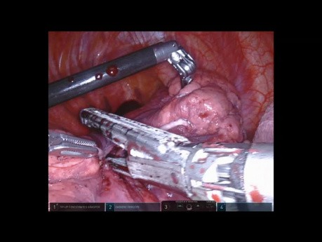 Prawostronna segmentektomia tylna górna z użyciem robota