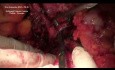 Operacja chirurgiczna raka połączenia żołądkowo-przełykowego (typu Garlocka)