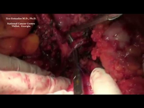 Operacja chirurgiczna raka połączenia żołądkowo-przełykowego (typu Garlocka)