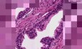 Przerost guzkowy - histopatologia gruczołu krokowego