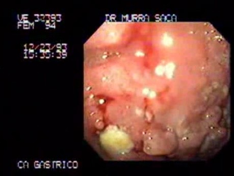 Naciekający rak żołądka - endoskopia