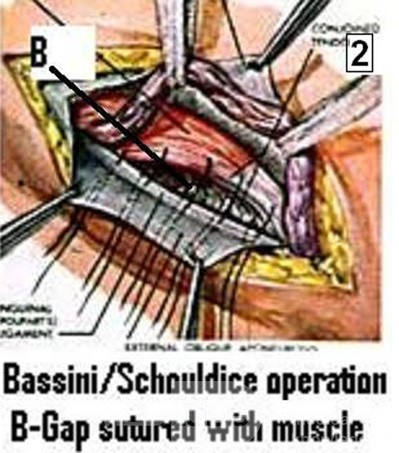 Przepuklina pachwinowa - metoda Bassiniego