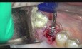Mikrochirurgia implantologiczna: implantacja natychmiastowa trzonowca