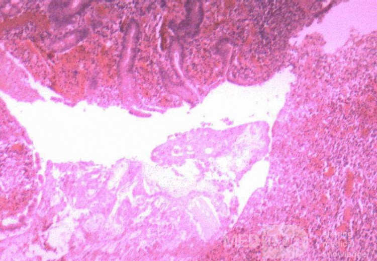 Mnogie wrzody odbytnicy (106 z 110)