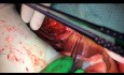 Pomostowanie aortalno-wieńcowe czterech naczyń z użyciem krążenia pozaustrojowego