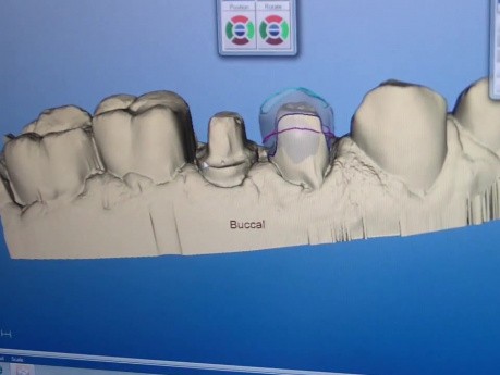 CEREC AC - Kiedy projekt idzie źle