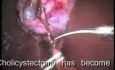 Leczenie laparoskopowe kamicy pęcherzyka żółciowego