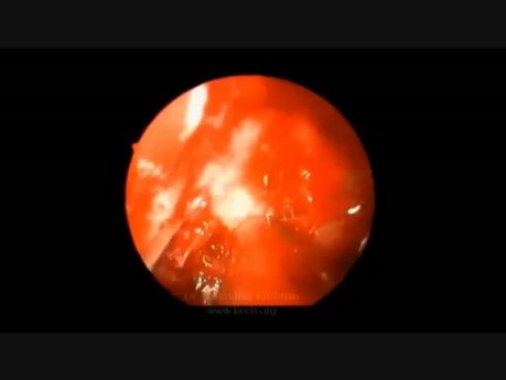 Endoskopowa dekompresja powypadkowego uszkodzenia nerwu wzrokowego