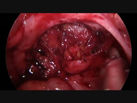 Częściowe usunięcie ogniska endometriozy naciekającej przednią ścianę odbytnicy