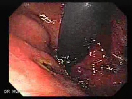 Wrzodziejący żylak żołądka - endoskopia