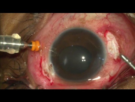 Leczenie pourazowego zapalenia wnętrza gałki ocznej