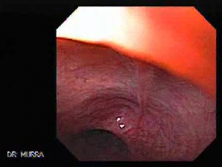 Mostki w obrębie błony śluzowej przełyku - przypadek 80-letniej kobiety