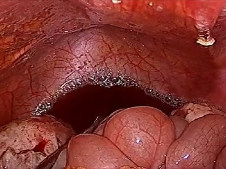 Operacja laparoskopowa torbieli endometrialnej 