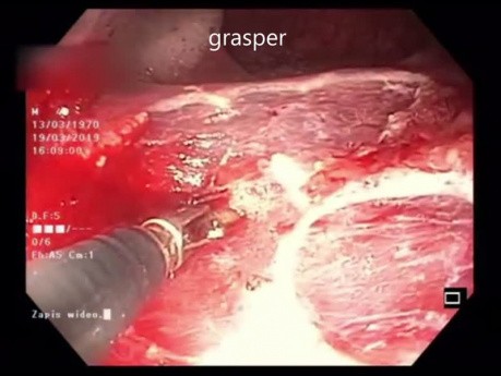 Endoskopowa resekcja błony śluzowej (EMR) typowego LST-G