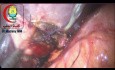Przypadkowa perforacja pęcherzyka żółciowego podczas cholecystektomii laparoskopowej