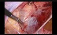 Podwiązanie tętnicy macicznej
