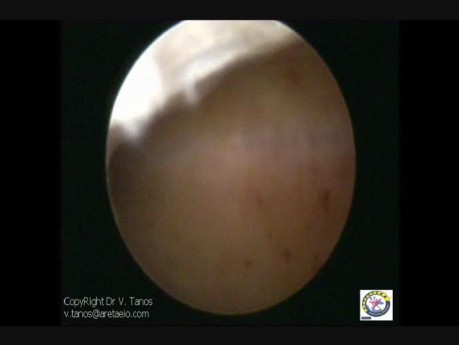 Histeroskopia second-look po resekcji przegrody