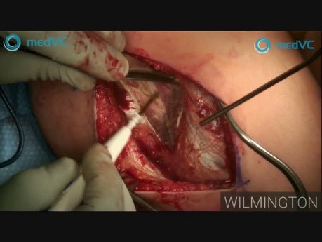 Osteotomia Degi - Orthopaedic Live Surgery Broadcast 2019