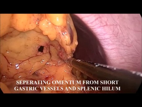 Omentektomia metodą laparoskopową