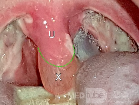 Obrzęk języczka po tonsilektomii