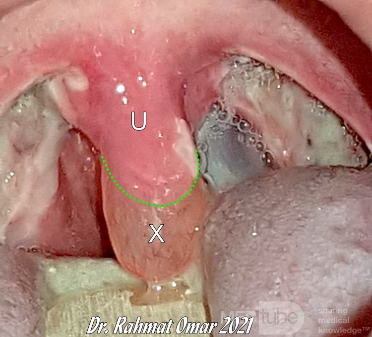 Obrzęk języczka po tonsilektomii