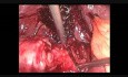 Minilaparoskopowa cholecystektomia