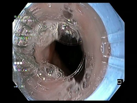 Opaskowanie żylaków przełyku