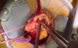 Ograniczona torakotomia w celu wymiany zastawki aortalnej