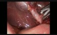 Radykalny zabieg laparoskopowej cholecystektomii 