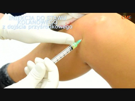PRP (osocze bogatopłytkowe) - iniekcja do stawu kolanowego