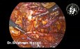 Chirurgia przepuklin brzusznych - Uwolnienie mięśnia poprzecznego brzucha (transversus abdominis release; TAR)