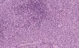 Peripheral T-cell lymphoma - Badanie histopatologiczne węzłów chłonnych