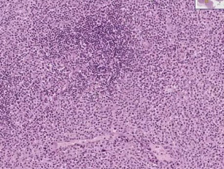 Peripheral T-cell lymphoma - Badanie histopatologiczne węzłów chłonnych
