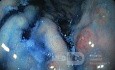 Nietypowy obraz polipów dna i trzonu żołądka w endoskopii. Chromoendoskopia. NET (4/6)