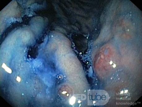 Nietypowy obraz polipów dna i trzonu żołądka w endoskopii. Chromoendoskopia. NET (4/6)