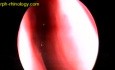 Krwotok z nosa z tętnicy sitowej przedniej