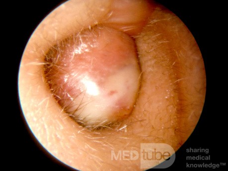Całkowite zwężenie przewodu słuchowego zewnętrznego przez keratynę