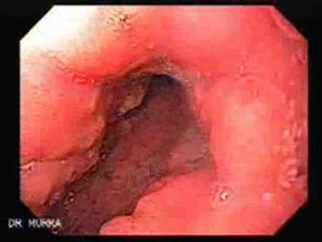 Rak włóknisty żołądka - endoskopia (3 z 47)