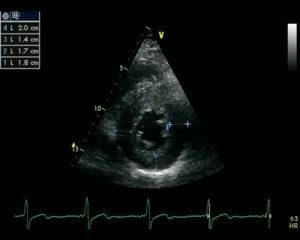 Kardiomiopatia przerostowa