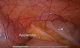 Diagnostyczna laparoskopia