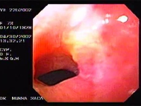 Gruczolakorak żołądka z komórkami sygnetowatymi - endoskopia (1 z 4)