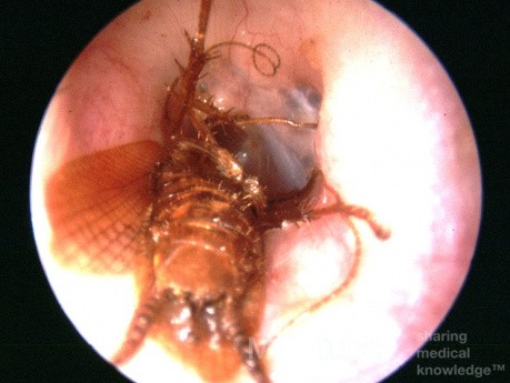Ciało obce (owad) w przewodzie słuchowym zewnętrznym