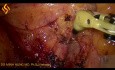 Laparoskopowe usunięcie węzłów chłonnych w raku okrężnicy wstępującej