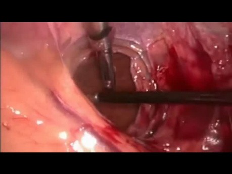 Adhezjoliza przed cholecystektomią laparoskopową